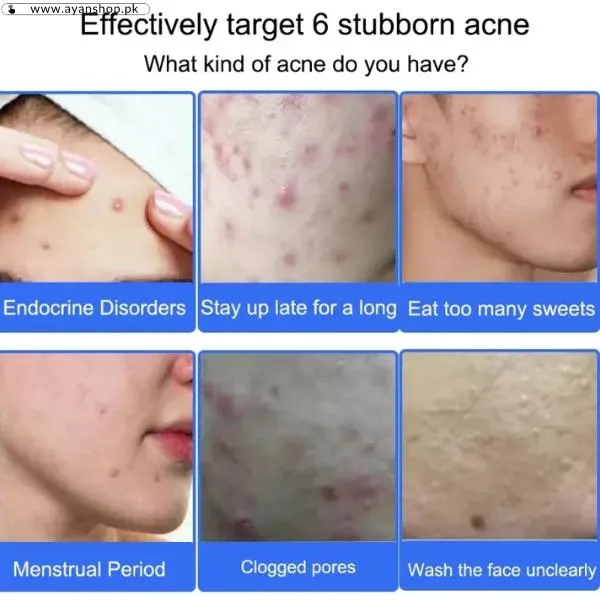 Uptown La Anti Acne Gel image 2
